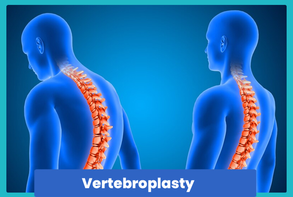 Vertrobroplasty