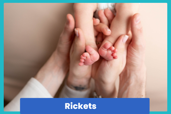 Rickets